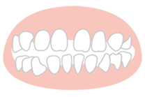 気になるすきっ歯を治すこともできます