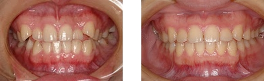 短期間で手軽に歯並びを治しませんか？