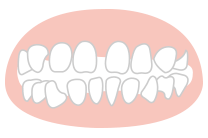どうしてすきっ歯になるのか？