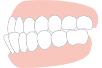 小さなお子様の受け口もきちんと治療します